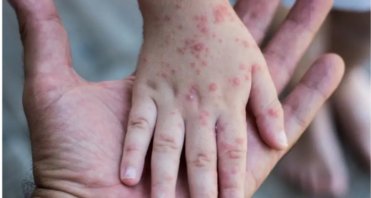 محجوب العوني: لا إصابات بفيروس ''جدري القرود'' في تونس