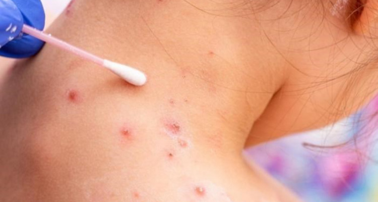 الصحة العالمية تكشف أسباب انتشار ''جدري القرود''