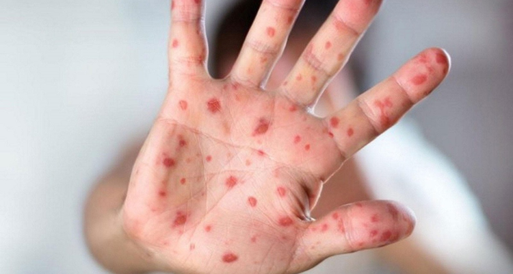 محجوب العوني: لم يتم التبليغ عن أية إصابة بجدري القردة في تونس