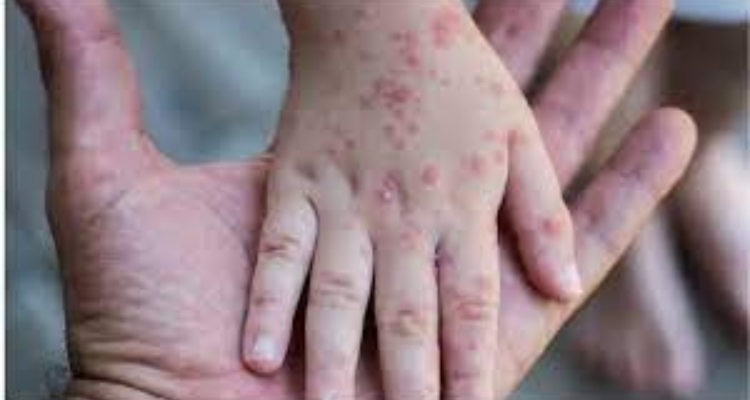 السعودية تُعلن عن رصد إصابة بمرض جدري القرود