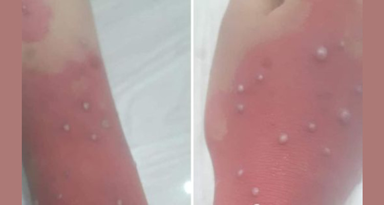 الاشتباه بتسجيل إصابة بجدري القردة: المدير الجهوي للصحة بصفاقس يوضّح