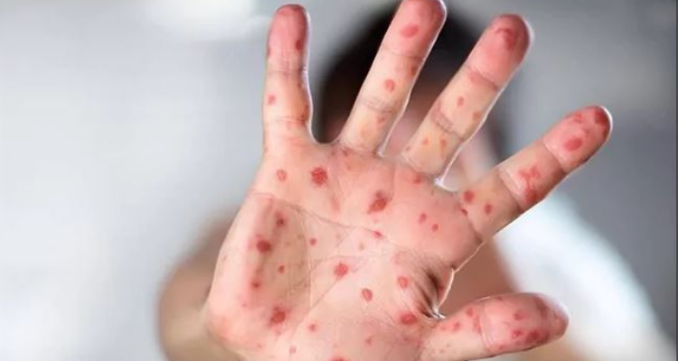 أندونيسيا تسجل أول إصابة بجدري القردة