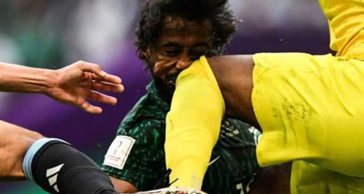 إصابة لاعب المنتخب السعودي ياسر الشهراني بكسر فى الفك وعظام الوجه