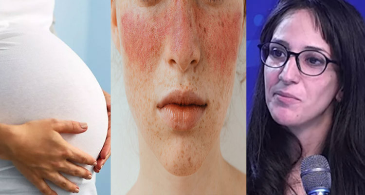 مرض الذئبة