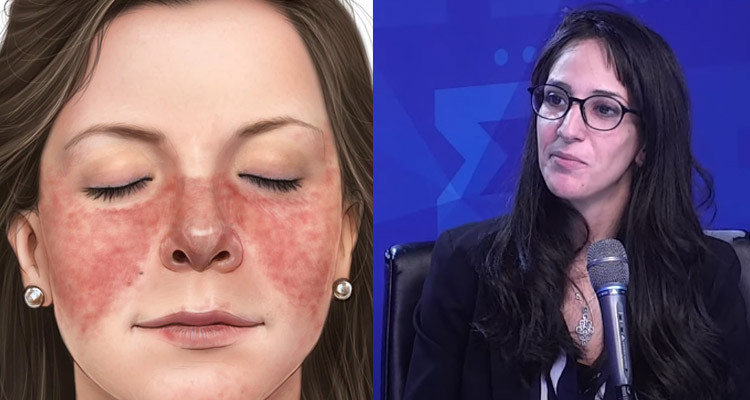 مرض الذئبة، يسرى فقيه غربال