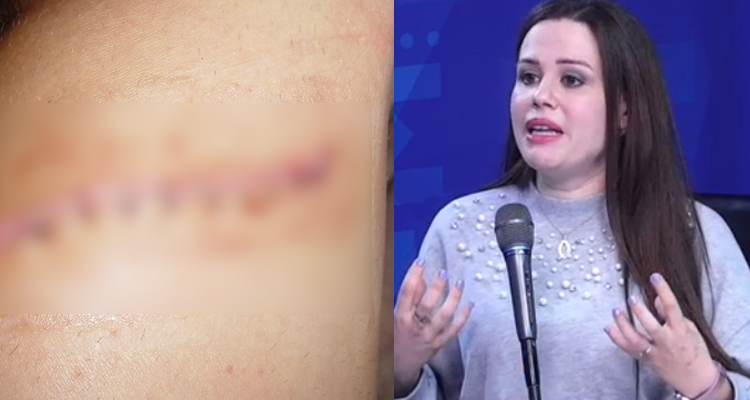 الندبات : هكذا يتم علاجها والدكتورة الشريف تكشف مدة التخلص منها