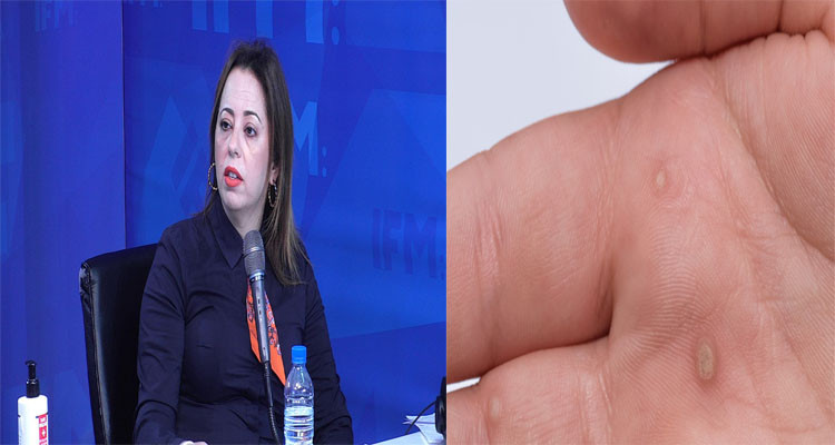 أخصائية في الأمراض الجلدية : 60% من الثآليل لدى الأطفال تختفي دون دواء