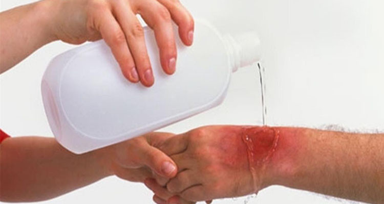 د.أمان الله المسعدي يقدم طرق الإسعافات الأولية لمعالجة الحروق