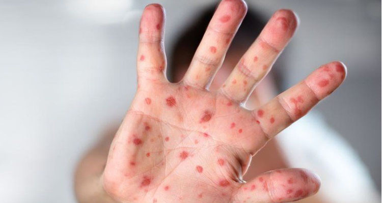 إسبانيا: تسجيل أول حالة وفاة بجدري القرود