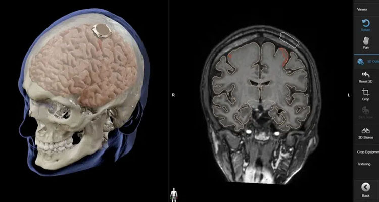 إيلون ماسك يعلن عن نجاح زرع شريحة دماغية في أول إنسان