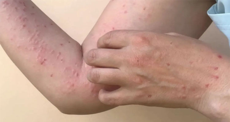 Tunisian Ministry of Health Confirms No Cases of Monkeypox Detected