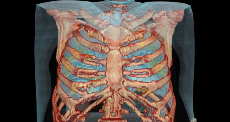كورونا رئتين
