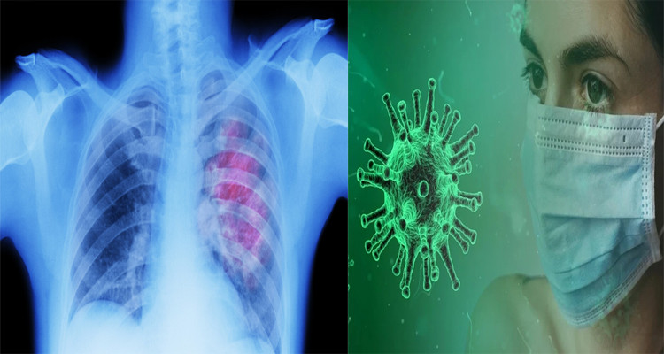 كورونا ثقب في الرئة