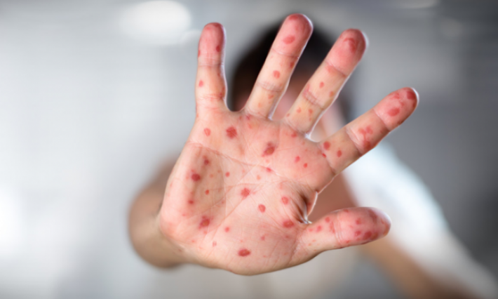 وزارة الصحة تطلق حملة للتدارك ضد الحصبة بهدف تلقيح الأطفال دون سن 6 سنوات