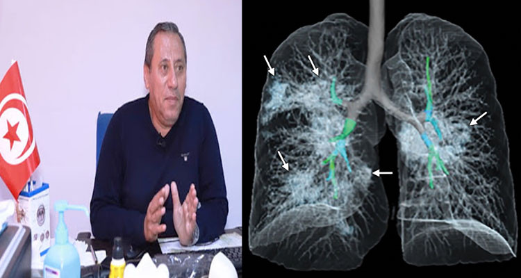 نفي فرضية دكتور الأشعة رضا فريعة المتعلقة بفيروس كورونا