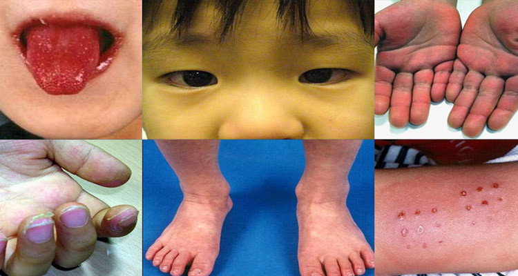 الدكتور محمد الدوعاجي: الكاوازاكي مرض معروف من قبل عند الأطفال 