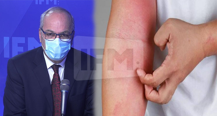 هاشمي الوزير: جدري القردة أقل خطورة م الكورونا وفما أدوية وتلاقيح 