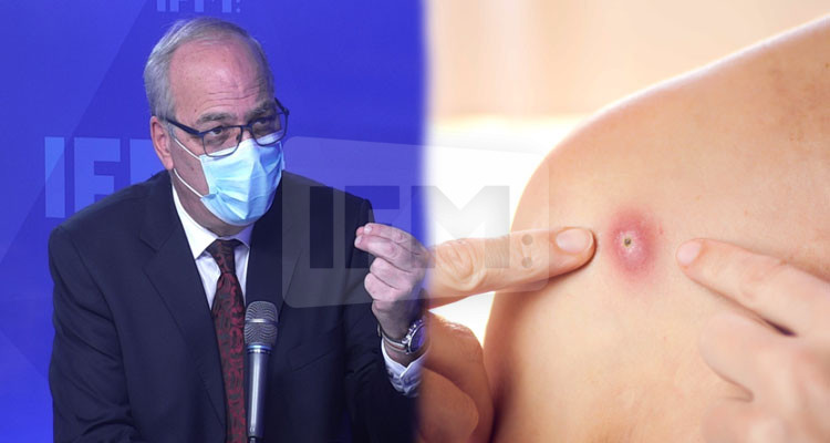 هاشمي الوزير: تلقيح الجدري يحمي من جدري القردة وينتقل بالاحتكاك 