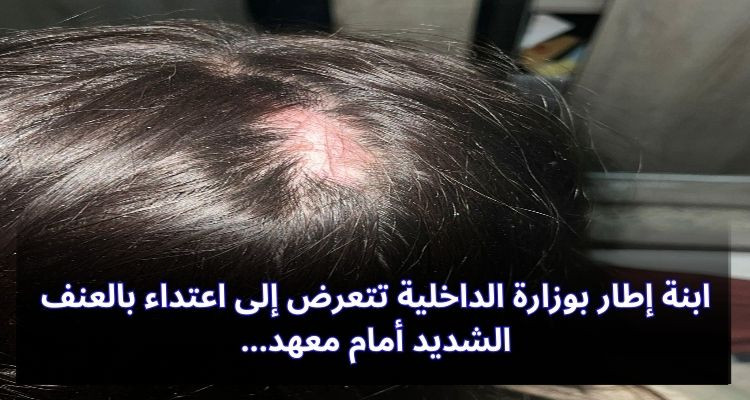 ابنة إطار بوزارة الداخلية تتعرض إلى اعتداء بالعنف الشديد أمام معهد