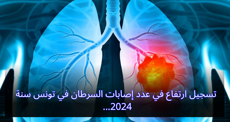 تسجيل ارتفاع في عدد إصابات السرطان في تونس سنة 2024