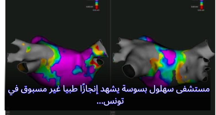مستشفى سهلول بسوسة يشهد إنجازًا طبيا غير مسبوق في تونس