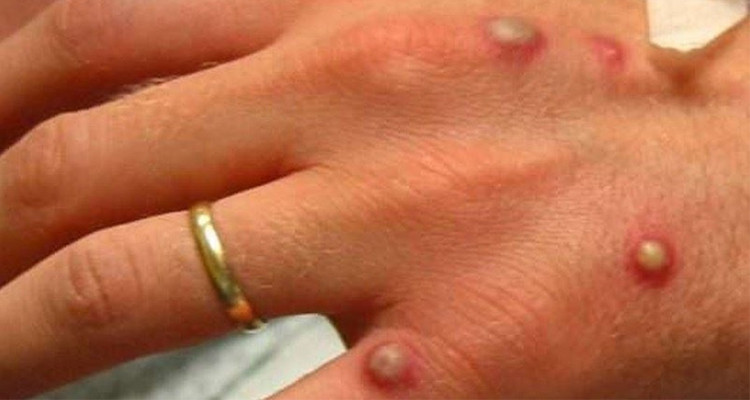 جدري القرود