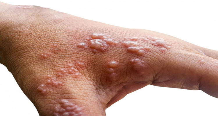 المغرب جدري القرود