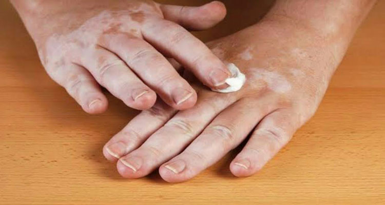 لأول مرة في التاريخ منح الترخيص لدواء يعالج "البرص"