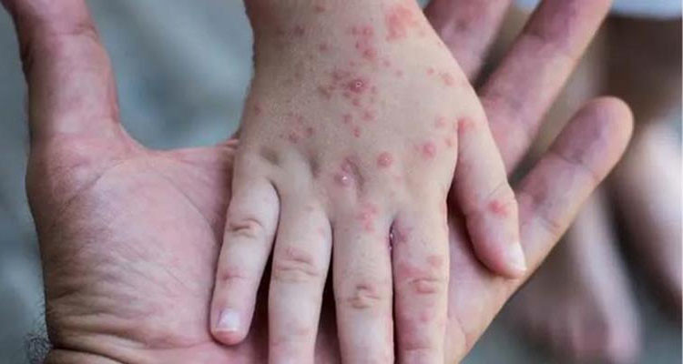 شروط الحجر الصحي للمصابين بجدري القردة وفق عالم أوبئة روسي