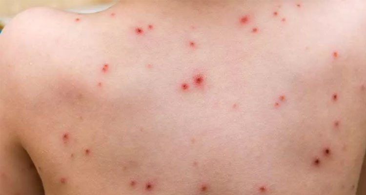 الصين تشدد إجراءاتها في الموانئ مع زيادة حالات الإصابة بجدري القرود في العالم