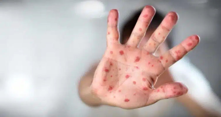 ارتفاع قياسي للإصابات بالحصبة حول العالم