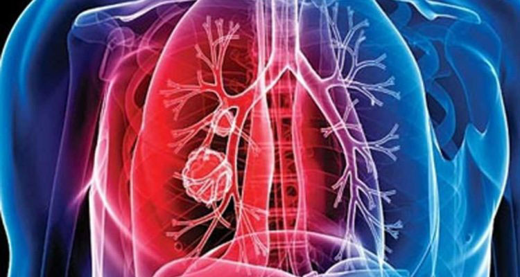 تسجيل 20 إصابة بمرض السل في ولاية نابل