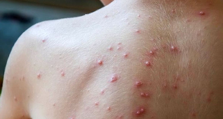 فرنسا تسجل أول إصابة بجدري القردة