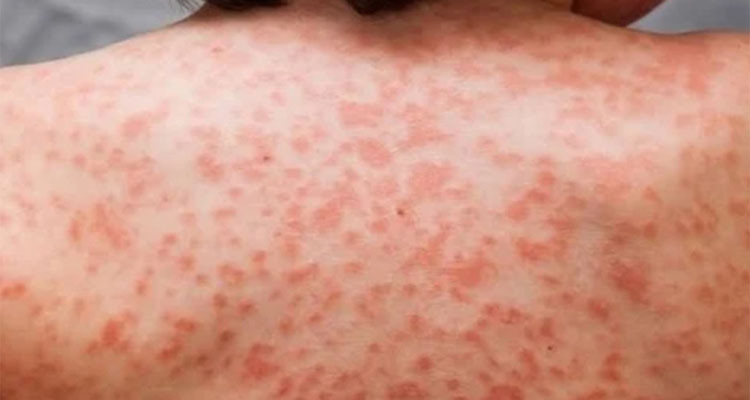 انتشار داء''بوحور'' المعدي بشكل غير مسبوق في المغرب