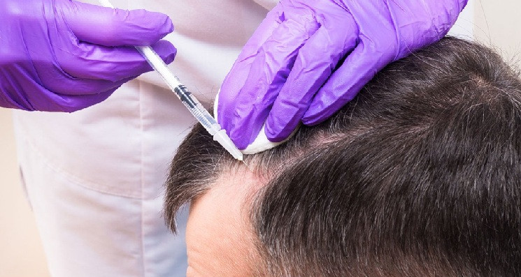 لماذا لا تكلّل عمليات زراعة الشعر عند النساء غالباً بالنجاح؟