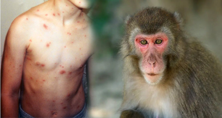 مدير الصحة بالمهدية ينفي إصابة مهاجرين غير نظاميين بجدري القرود 