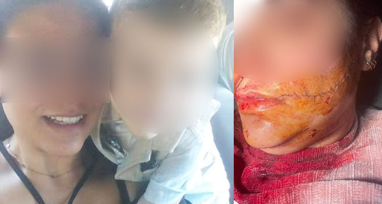 تصدت لمحاولته سرقة أغراضها فشوّه وجهها بآلة حادة
