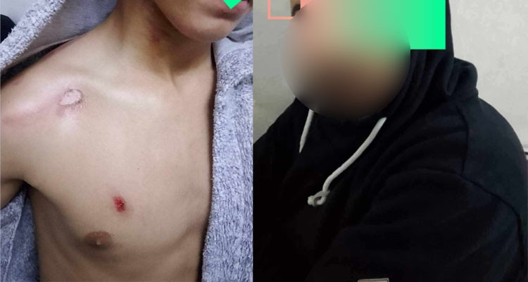 سوسة: يعتدي بالحرق على فلذة كبده في أنحاء متفرقة من جسده