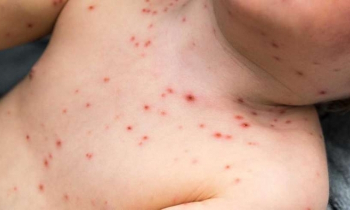 انطلاق الحملة الوطنية للتدارك ضد الحصبة لفائدة الأطفال دون الـ 6 سنوات بسليانة