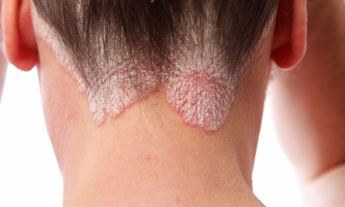 Journée mondiale du psoriasis 