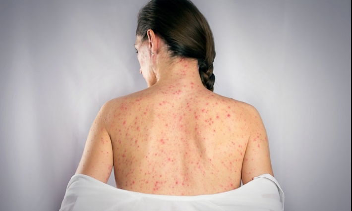Campagne nationale de vaccination contre la rougeole 