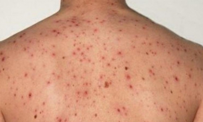 وزير الصحة يقر بوجود فيروس الحصبة في القصرين