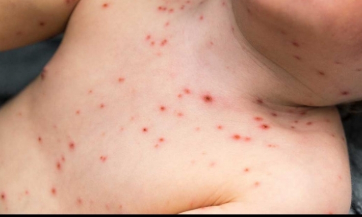 القصرين: ارتفاع عدد الإصابات بفيروس الحصبة إلى 580 حالة منذ جانفي المنقضي