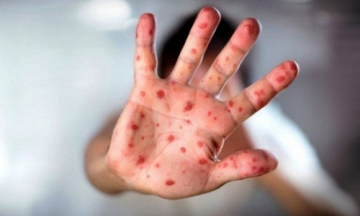 سيدي بوزيد: التحاليل المخبرية تؤكد 33 حالة إيجابية من بين 100 حالة مشتبه في إصابتها بمرض الحصبة