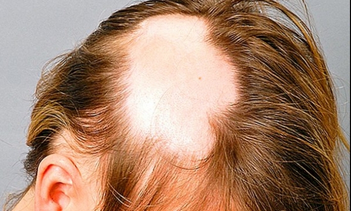 القصرين: عزل صحي لتلاميذ مصابين بـ " القرع" المعدي بمدرسة في سبيطلة